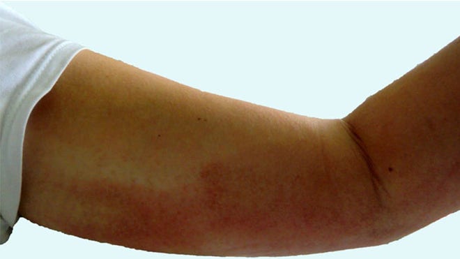 cowpox ulcer 1 BMJ.jpg